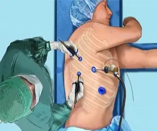 Thoracic Surgery